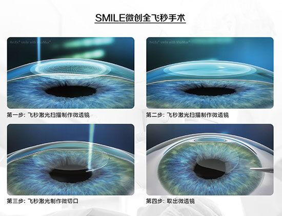 蔡司全飛秒、蔡司半飛秒近視手術與蔡司全飛秒flex手術