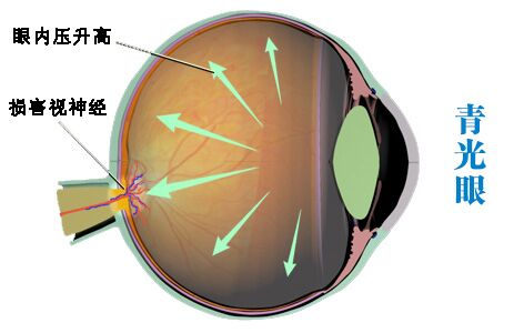 青光眼做手術有哪些利弊