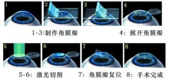 準分子激光手術到底是怎么治 愈你的眼睛的？