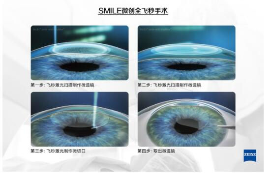 準分子激光手術到底是怎么治 愈你的眼睛的？