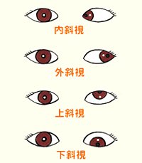 斜視檢查之注視性質分類及檢查方法