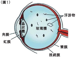 高度近視怎么辦?視網膜脫落能嗎?