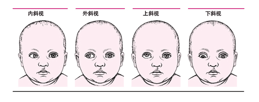 斜視眼怎么?斜視手術要休息多久?