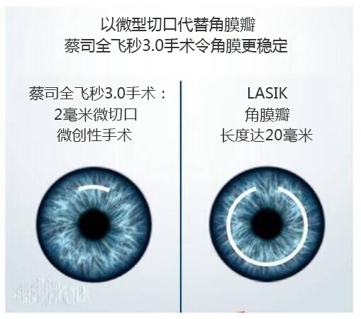 做完近視手術(shù)要休息多長時間？需要住院嗎？