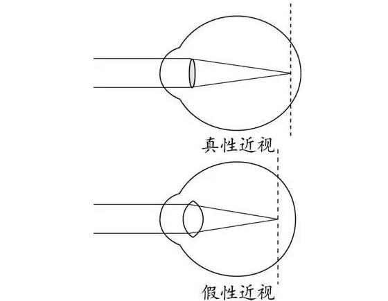 醫(yī)學小方法：檢測真性近視還是假性近視