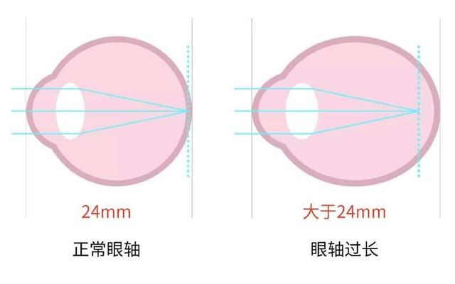 眼科醫生解密：哪些行為近視度數增長快